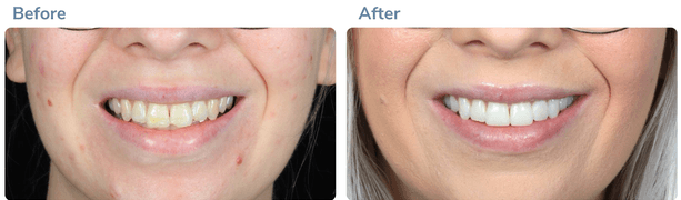 Smile transformation before and after 1