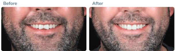 Smile transformation before and after 2