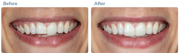 Smile transformation before and after 3